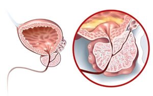 Prostatit ve erektil disfonksiyonda düşük yoğunluklu şok dalga (ED-SWT) uygulamasını gösteren tıbbi illüstrasyon; perine/prostat bölgesi ve penise yönlendirilen dalgalar, kanlanma ve seans bilgileri.