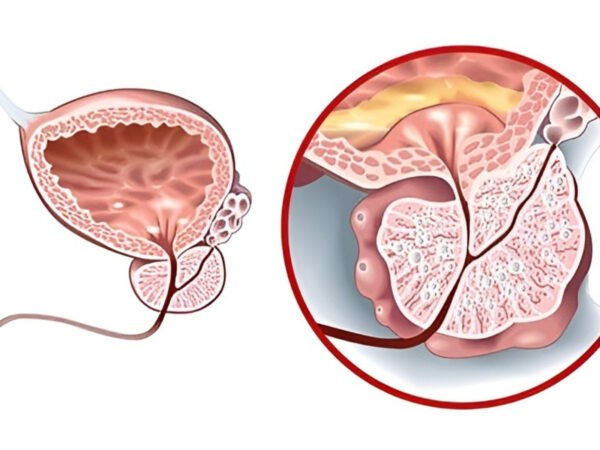 Prostatit ve erektil disfonksiyonda düşük yoğunluklu şok dalga (ED-SWT) uygulamasını gösteren tıbbi illüstrasyon; perine/prostat bölgesi ve penise yönlendirilen dalgalar, kanlanma ve seans bilgileri.