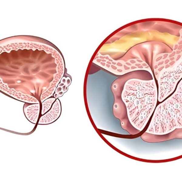 Prostatit ve erektil disfonksiyonda düşük yoğunluklu şok dalga (ED-SWT) uygulamasını gösteren tıbbi illüstrasyon; perine/prostat bölgesi ve penise yönlendirilen dalgalar, kanlanma ve seans bilgileri.